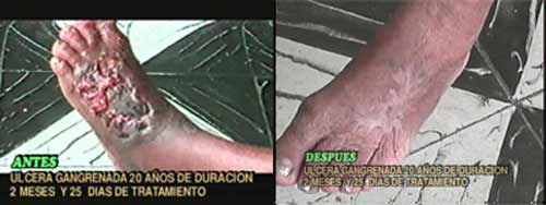 Ulcera Gangrenada